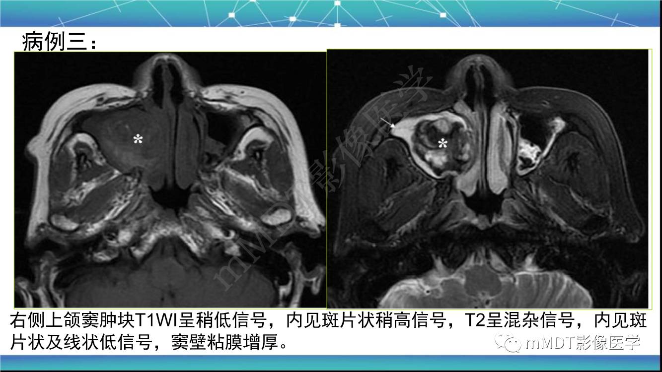 影像PPT - 【PPT】出血坏死性鼻息肉CT/MRI诊断-13