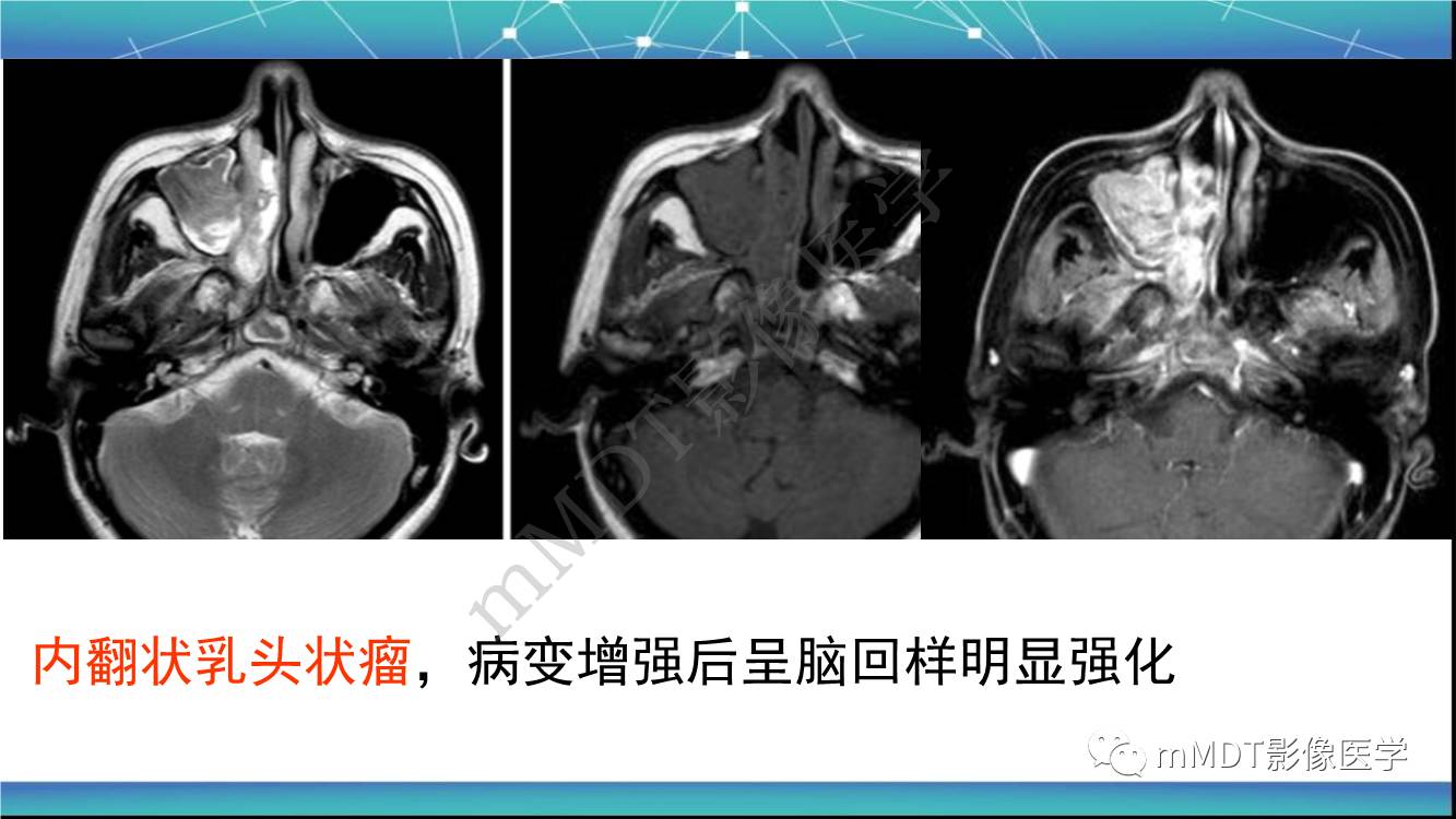 影像PPT - 【PPT】出血坏死性鼻息肉CT/MRI诊断-18