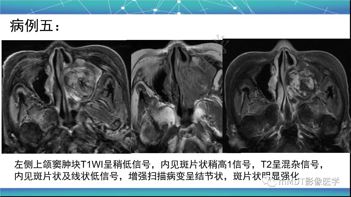 影像PPT - 【PPT】出血坏死性鼻息肉CT/MRI诊断-15