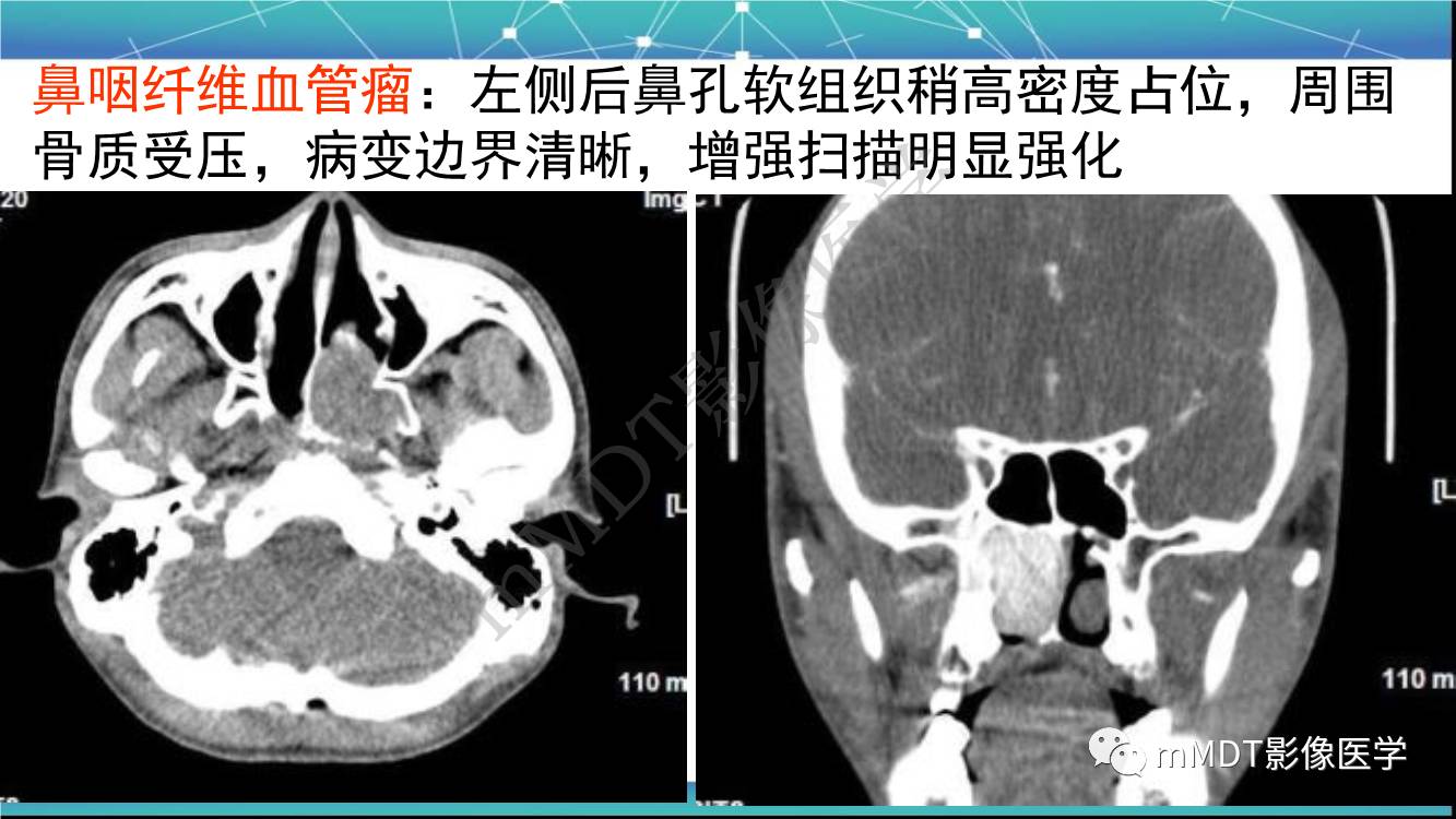 影像PPT - 【PPT】出血坏死性鼻息肉CT/MRI诊断-20