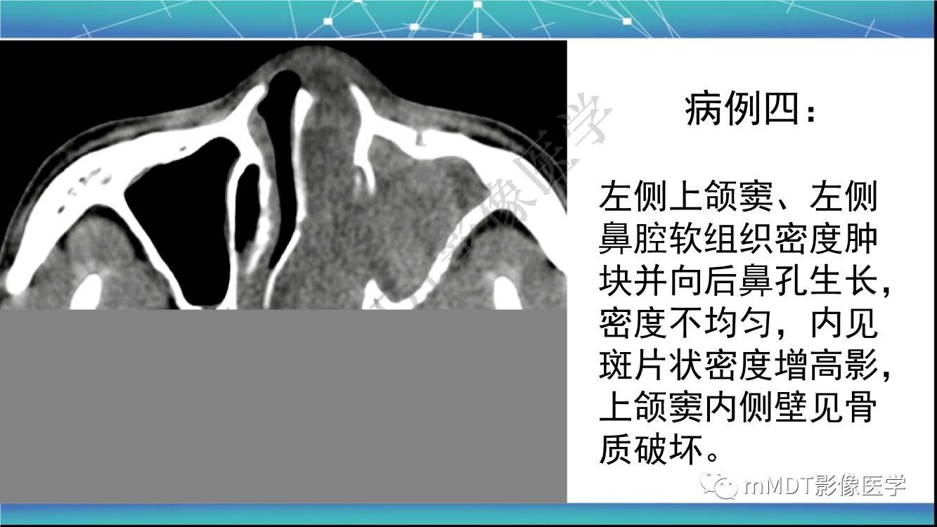 影像PPT - 【PPT】出血坏死性鼻息肉CT/MRI诊断-14