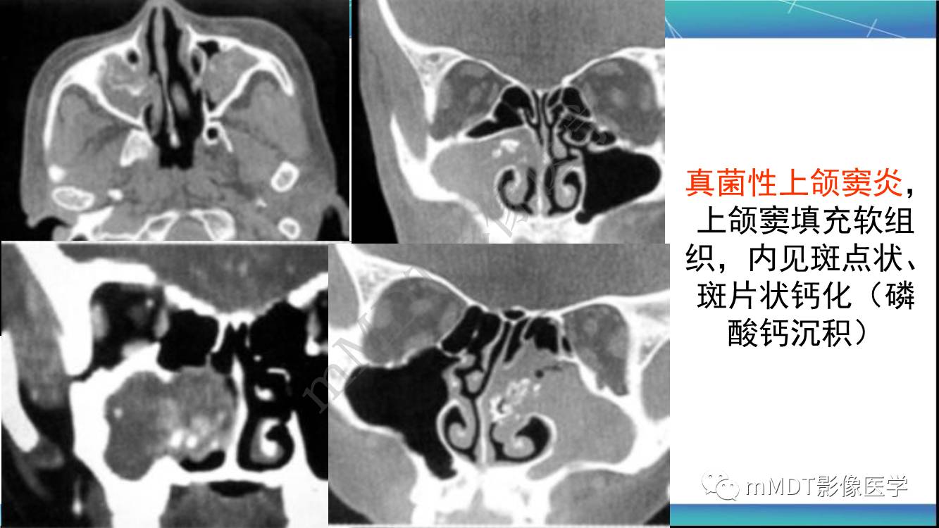 影像PPT - 【PPT】出血坏死性鼻息肉CT/MRI诊断-22
