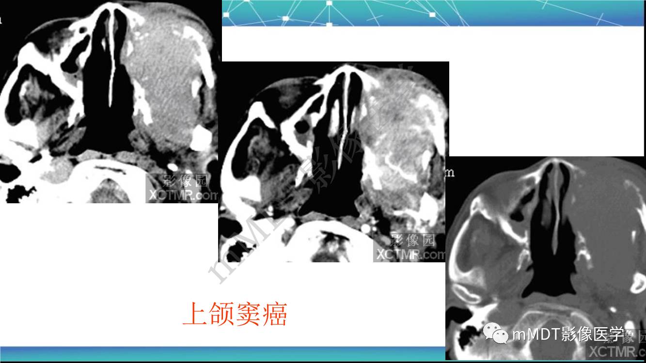 影像PPT - 【PPT】出血坏死性鼻息肉CT/MRI诊断-26