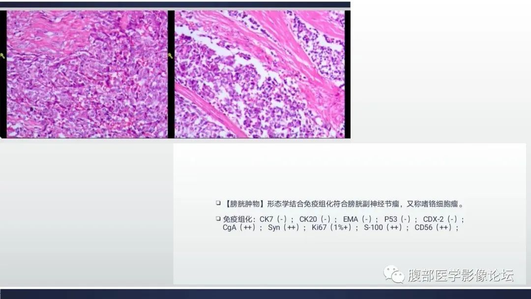 影像PPT - 【病例】膀胱副神经节瘤(嗜铬细胞瘤)1例CT及MR-4 影像PPT - 【病例】膀胱副神经节瘤(嗜铬细胞瘤)1例CT及MR-4