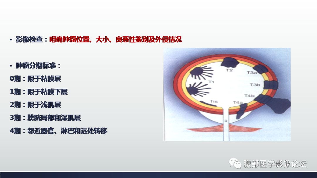 影像PPT - 【病例】膀胱副神经节瘤(嗜铬细胞瘤)1例CT及MR-6 影像PPT - 【病例】膀胱副神经节瘤(嗜铬细胞瘤)1例CT及MR-6