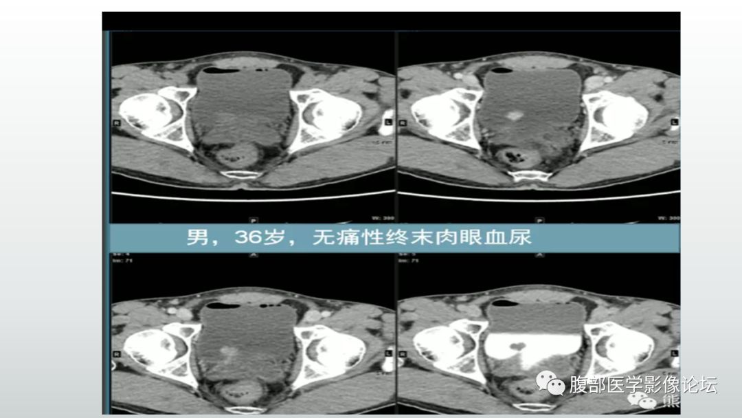 影像PPT - 【病例】膀胱副神经节瘤(嗜铬细胞瘤)1例CT及MR-10 影像PPT - 【病例】膀胱副神经节瘤(嗜铬细胞瘤)1例CT及MR-10