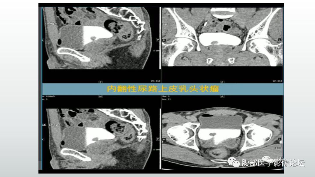 影像PPT - 【病例】膀胱副神经节瘤(嗜铬细胞瘤)1例CT及MR-11 影像PPT - 【病例】膀胱副神经节瘤(嗜铬细胞瘤)1例CT及MR-11