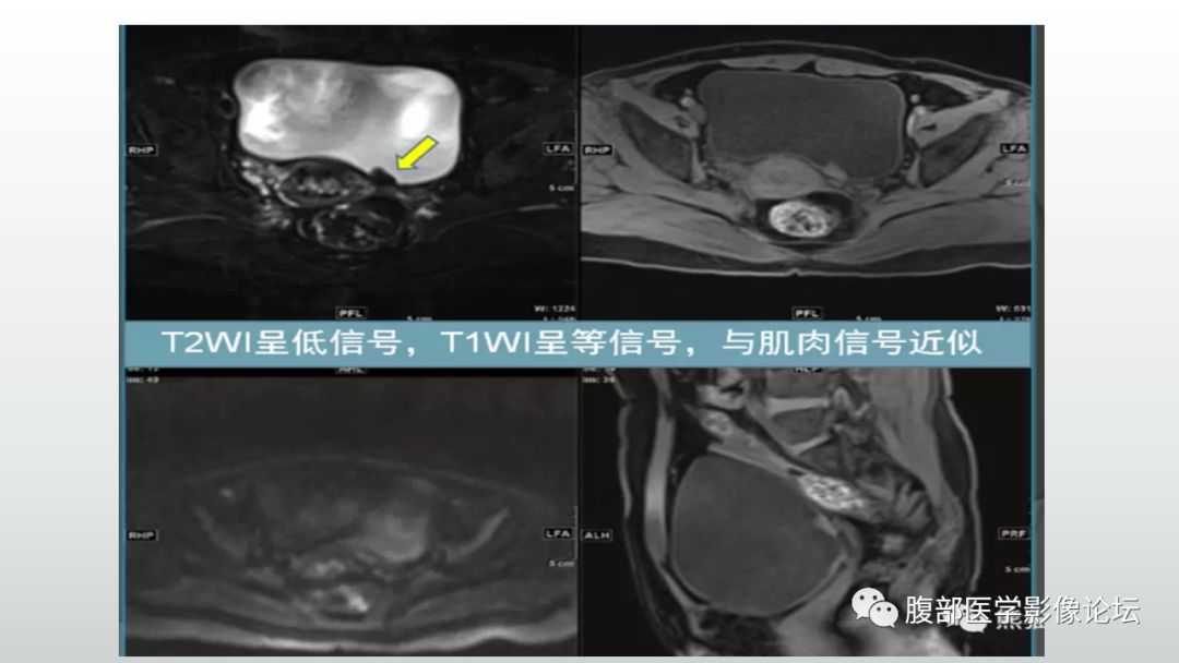 影像PPT - 【病例】膀胱副神经节瘤(嗜铬细胞瘤)1例CT及MR-15 影像PPT - 【病例】膀胱副神经节瘤(嗜铬细胞瘤)1例CT及MR-15