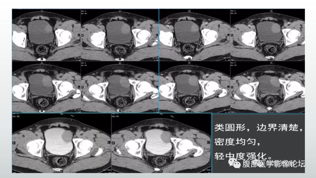 影像PPT - 【病例】膀胱副神经节瘤(嗜铬细胞瘤)1例CT及MR-16 影像PPT - 【病例】膀胱副神经节瘤(嗜铬细胞瘤)1例CT及MR-16