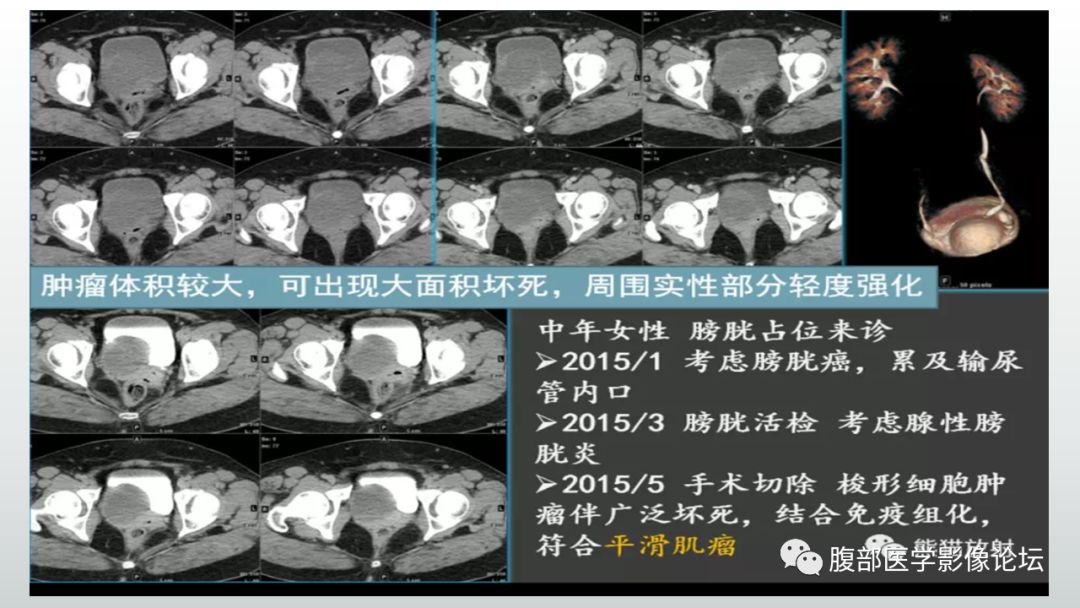 影像PPT - 【病例】膀胱副神经节瘤(嗜铬细胞瘤)1例CT及MR-17 影像PPT - 【病例】膀胱副神经节瘤(嗜铬细胞瘤)1例CT及MR-17