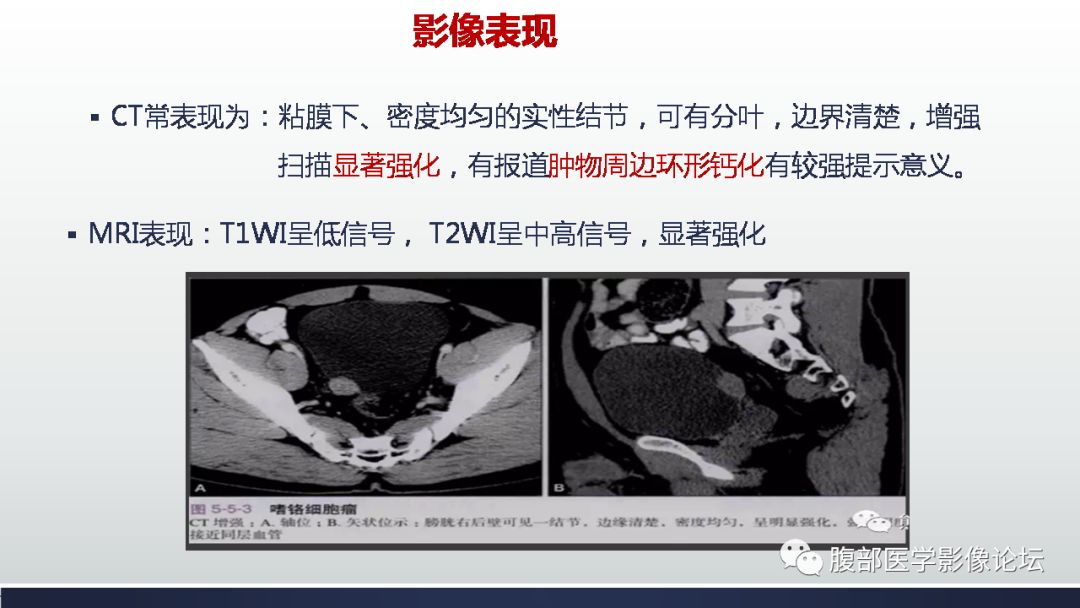 影像PPT - 【病例】膀胱副神经节瘤(嗜铬细胞瘤)1例CT及MR-19 影像PPT - 【病例】膀胱副神经节瘤(嗜铬细胞瘤)1例CT及MR-19