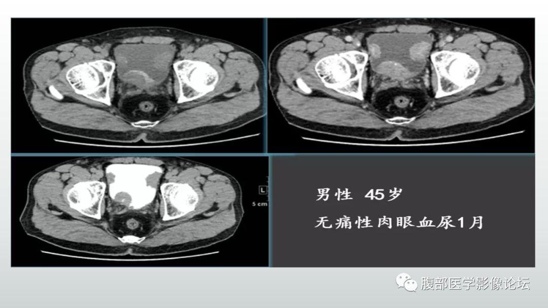 影像PPT - 【病例】膀胱副神经节瘤(嗜铬细胞瘤)1例CT及MR-22 影像PPT - 【病例】膀胱副神经节瘤(嗜铬细胞瘤)1例CT及MR-22