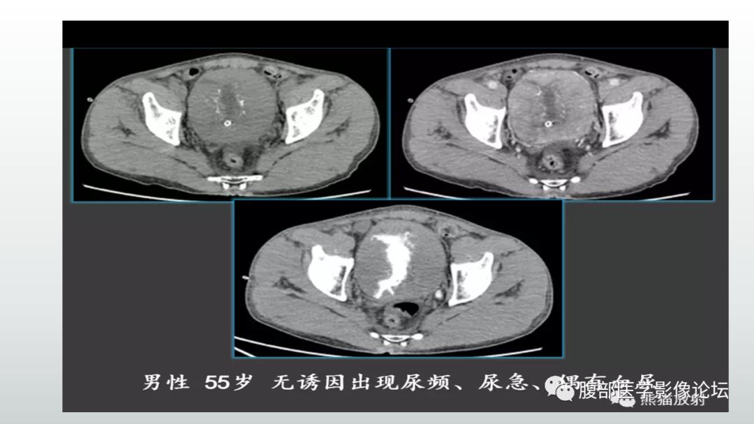 影像PPT - 【病例】膀胱副神经节瘤(嗜铬细胞瘤)1例CT及MR-23 影像PPT - 【病例】膀胱副神经节瘤(嗜铬细胞瘤)1例CT及MR-23
