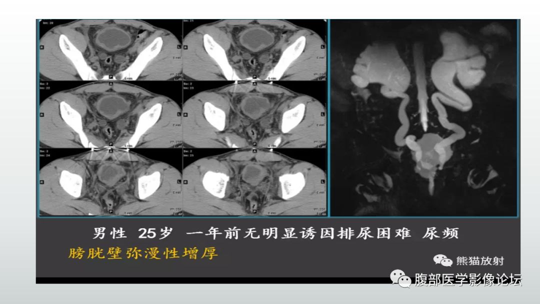 影像PPT - 【病例】膀胱副神经节瘤(嗜铬细胞瘤)1例CT及MR-26 影像PPT - 【病例】膀胱副神经节瘤(嗜铬细胞瘤)1例CT及MR-26