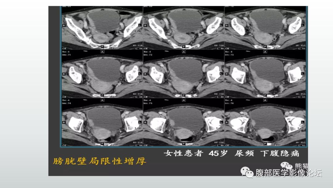 影像PPT - 【病例】膀胱副神经节瘤(嗜铬细胞瘤)1例CT及MR-27 影像PPT - 【病例】膀胱副神经节瘤(嗜铬细胞瘤)1例CT及MR-27