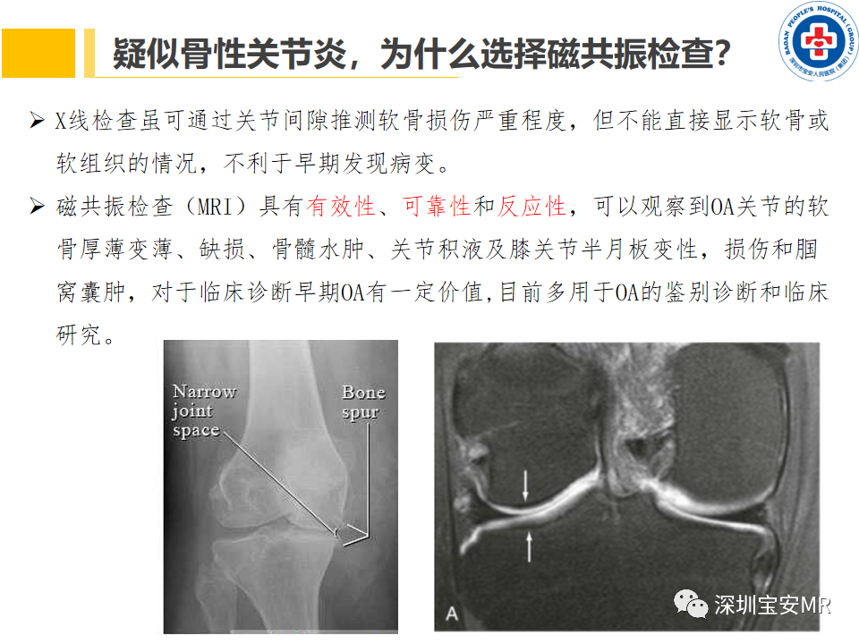 影像PPT - 【PPT】常见疾病—骨性关节炎磁共振检查-6