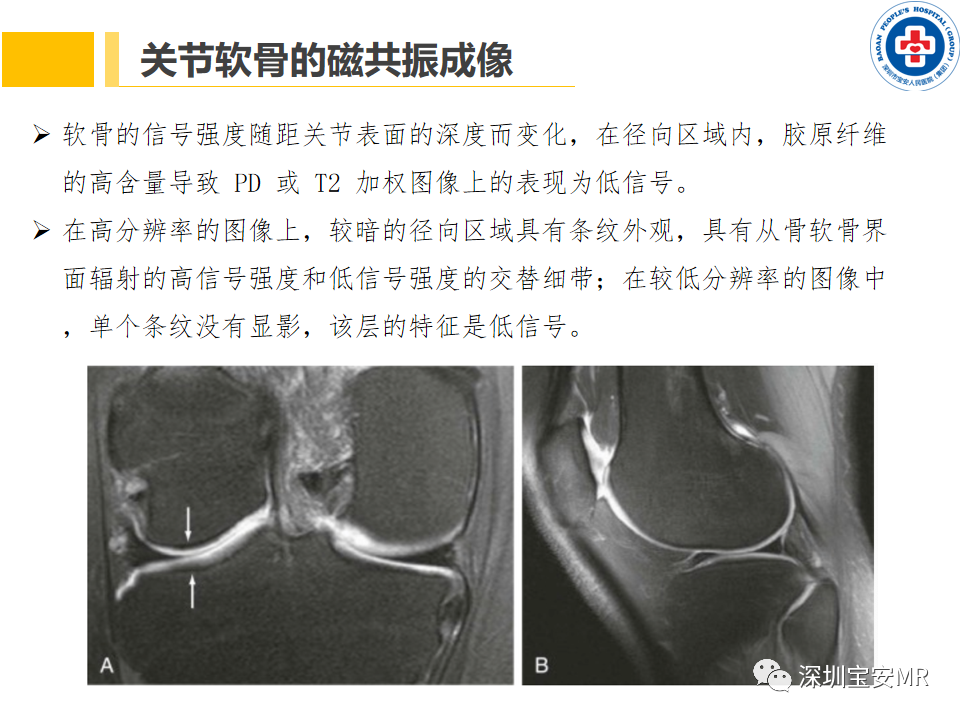 影像PPT - 【PPT】常见疾病—骨性关节炎磁共振检查-9