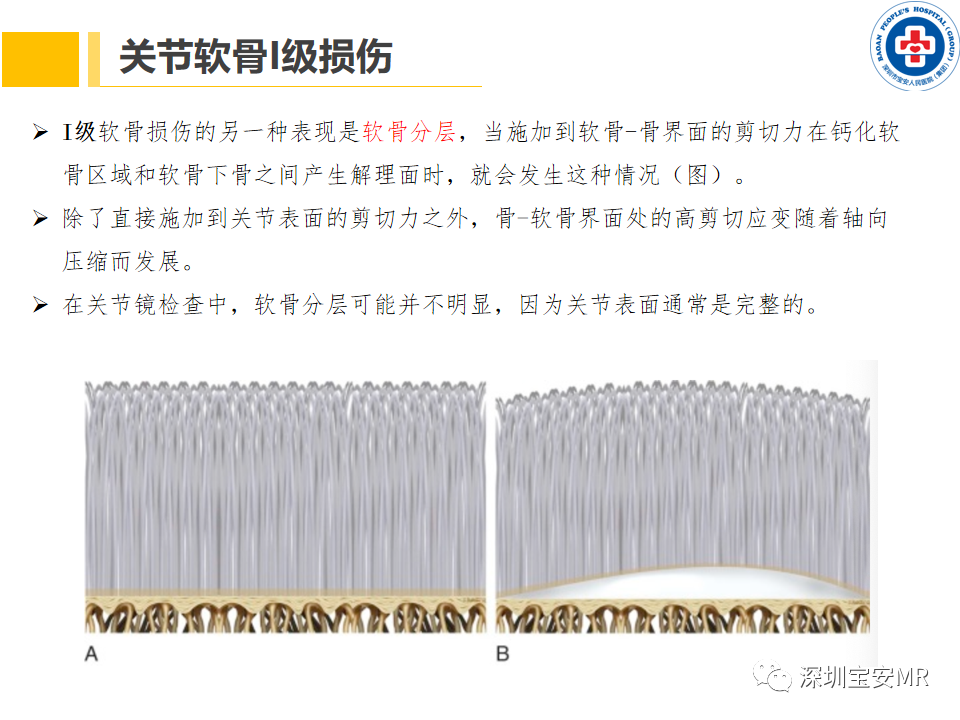 影像PPT - 【PPT】常见疾病—骨性关节炎磁共振检查-14