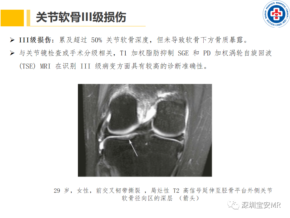 影像PPT - 【PPT】常见疾病—骨性关节炎磁共振检查-17