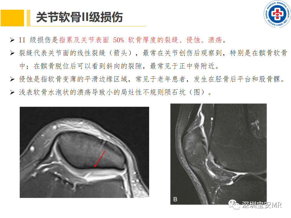 影像PPT - 【PPT】常见疾病—骨性关节炎磁共振检查-16