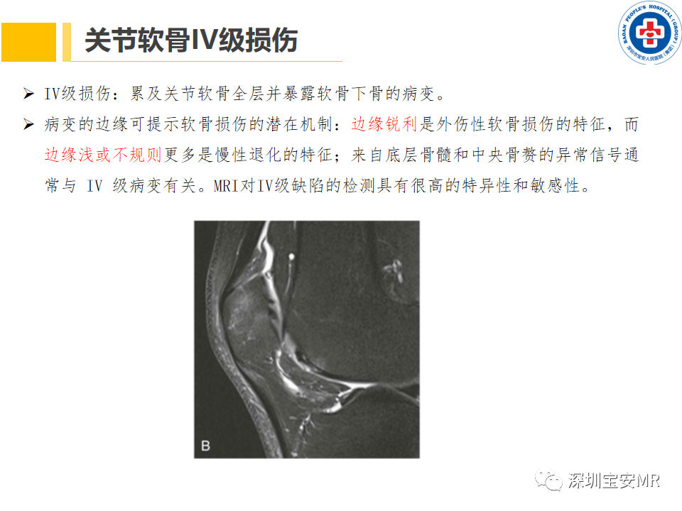 影像PPT - 【PPT】常见疾病—骨性关节炎磁共振检查-18