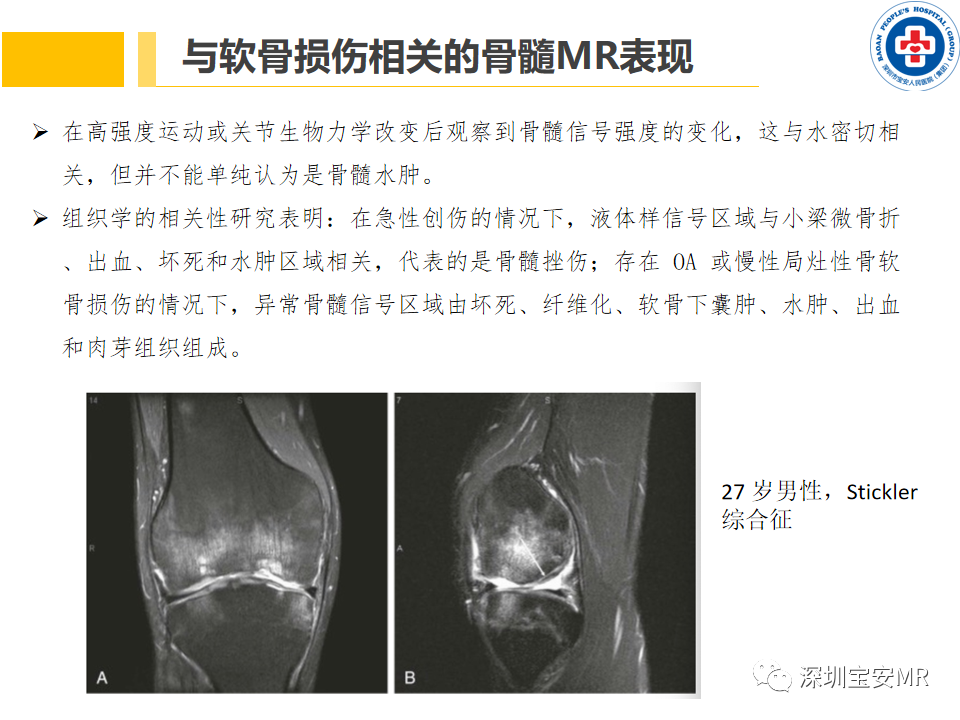 影像PPT - 【PPT】常见疾病—骨性关节炎磁共振检查-19