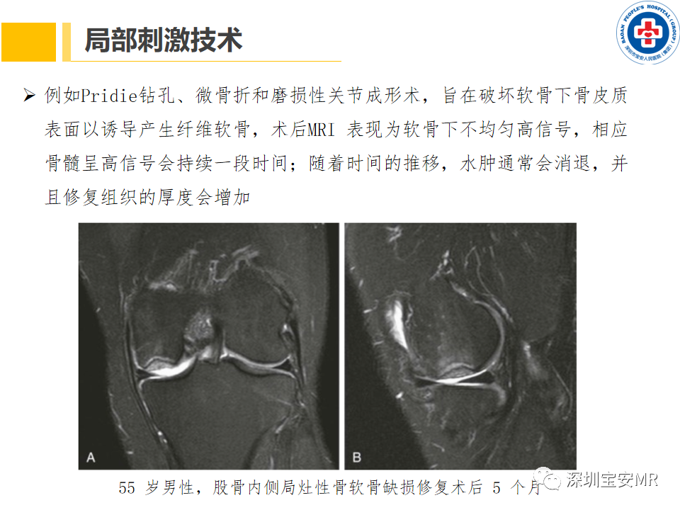影像PPT - 【PPT】常见疾病—骨性关节炎磁共振检查-21