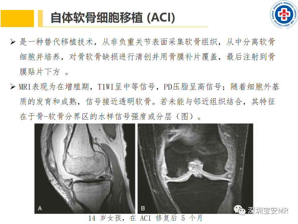 影像PPT - 【PPT】常见疾病—骨性关节炎磁共振检查-22