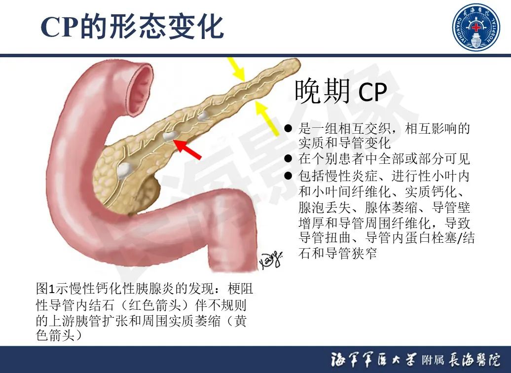 影像PPT - 【PPT】基于横断面成像来评估慢性胰腺炎严重程度：为什么有必要和如何进行-7