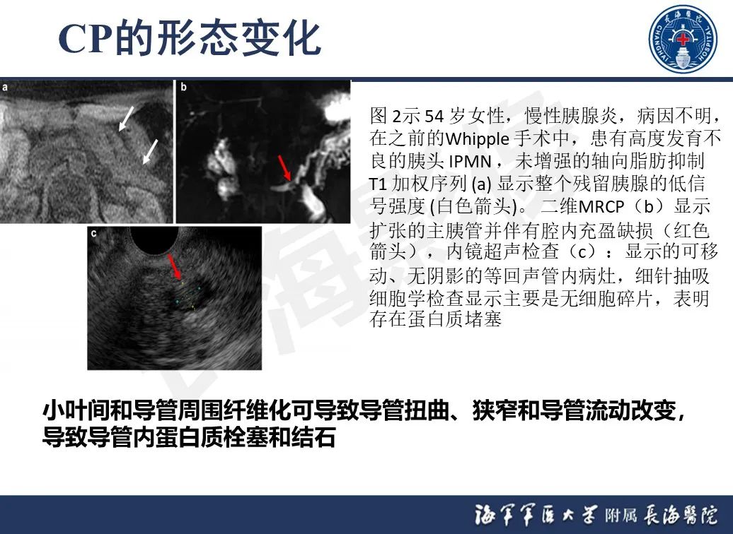 影像PPT - 【PPT】基于横断面成像来评估慢性胰腺炎严重程度：为什么有必要和如何进行-8