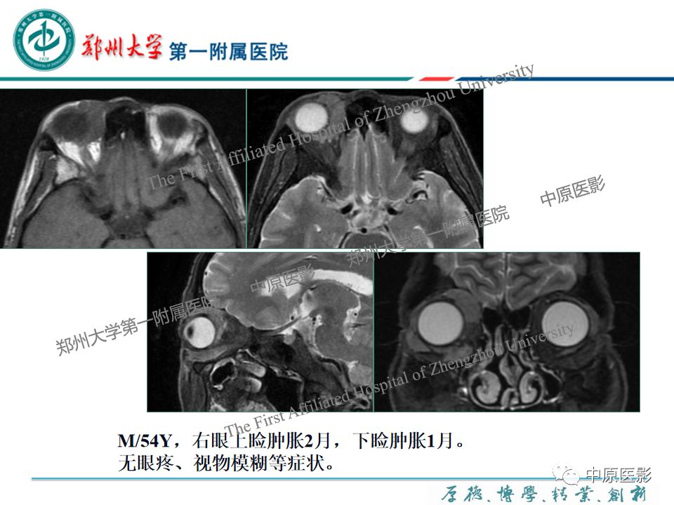 影像PPT - 【PPT】眼眶淋巴瘤的MRI诊断-5