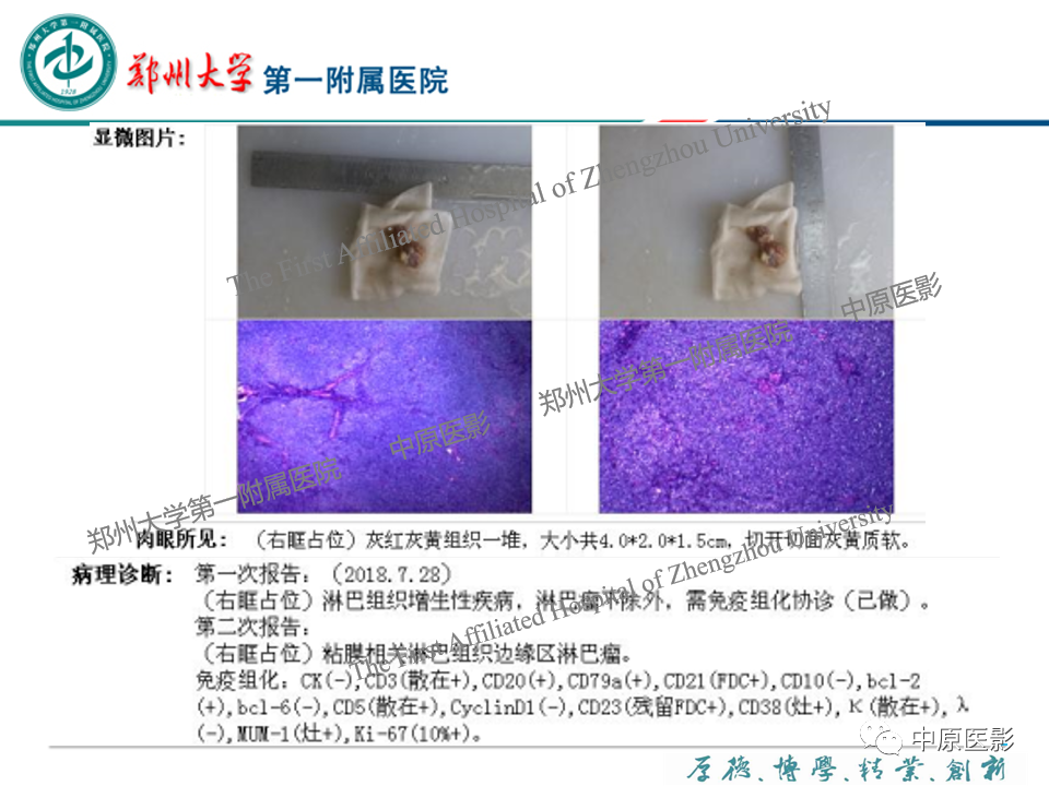 影像PPT - 【PPT】眼眶淋巴瘤的MRI诊断-7
