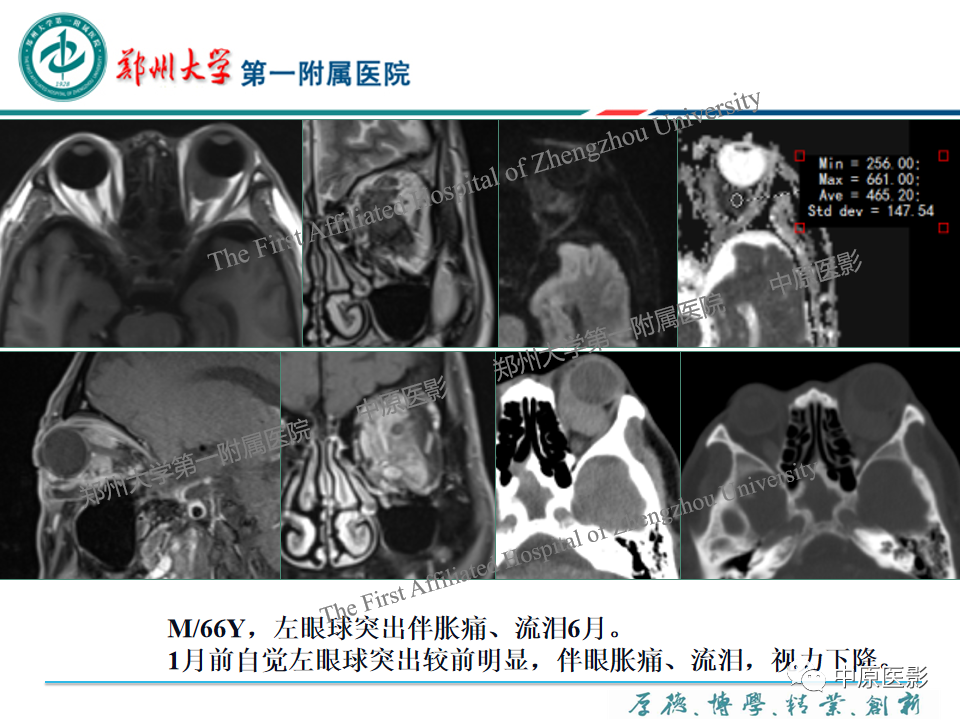 影像PPT - 【PPT】眼眶淋巴瘤的MRI诊断-31