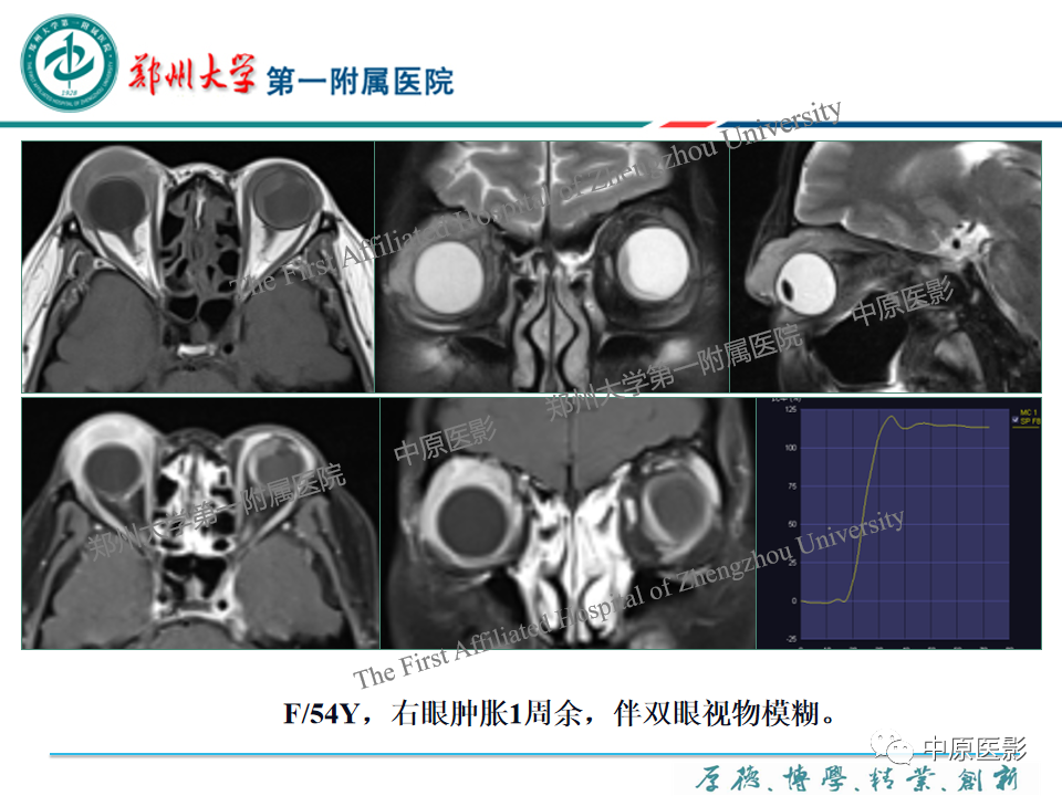 影像PPT - 【PPT】眼眶淋巴瘤的MRI诊断-17