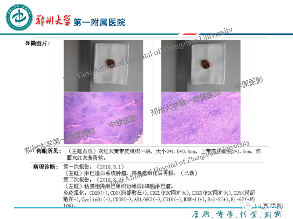 影像PPT - 【PPT】眼眶淋巴瘤的MRI诊断-13