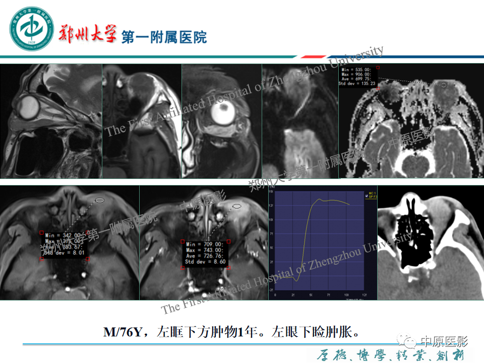 影像PPT - 【PPT】眼眶淋巴瘤的MRI诊断-11