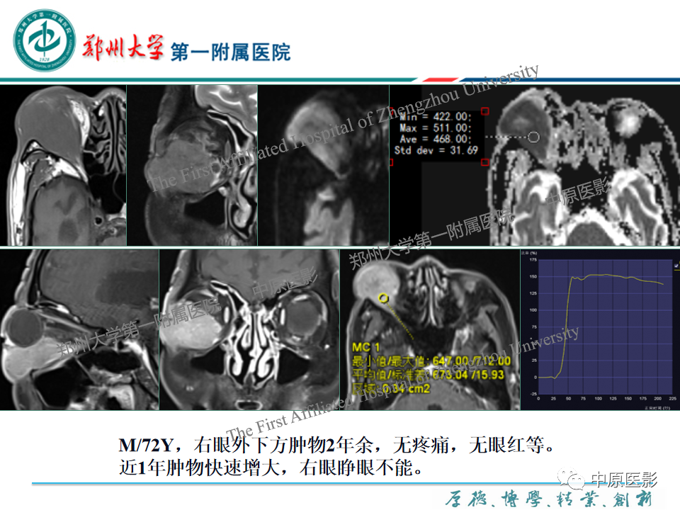 影像PPT - 【PPT】眼眶淋巴瘤的MRI诊断-14