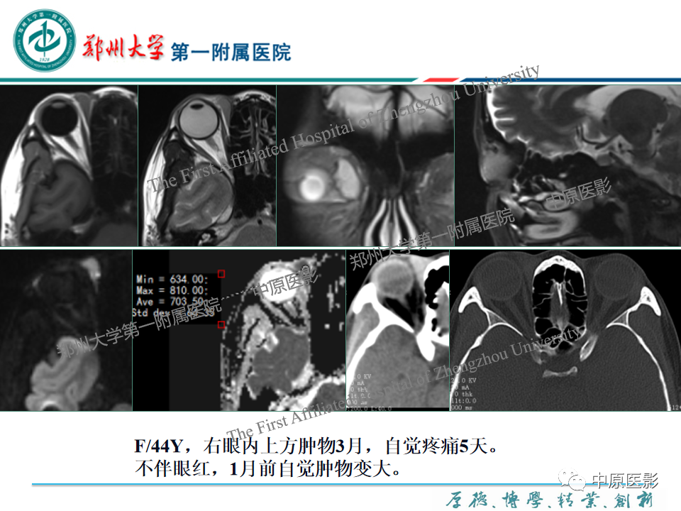 影像PPT - 【PPT】眼眶淋巴瘤的MRI诊断-19