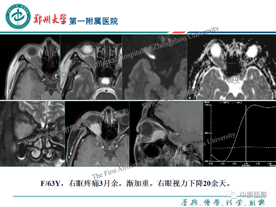 影像PPT - 【PPT】眼眶淋巴瘤的MRI诊断-37