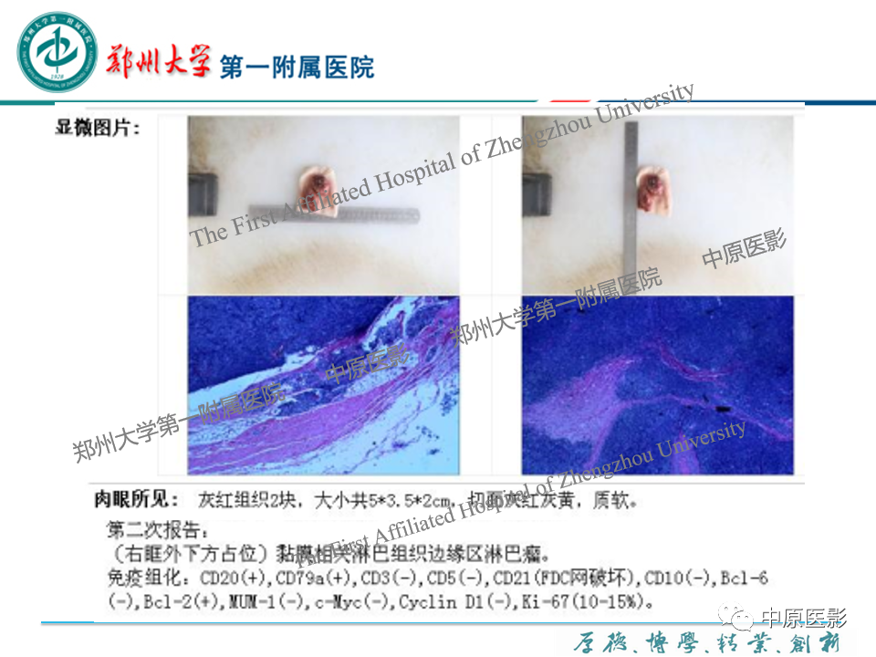 影像PPT - 【PPT】眼眶淋巴瘤的MRI诊断-16