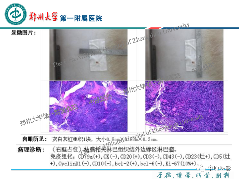 影像PPT - 【PPT】眼眶淋巴瘤的MRI诊断-36