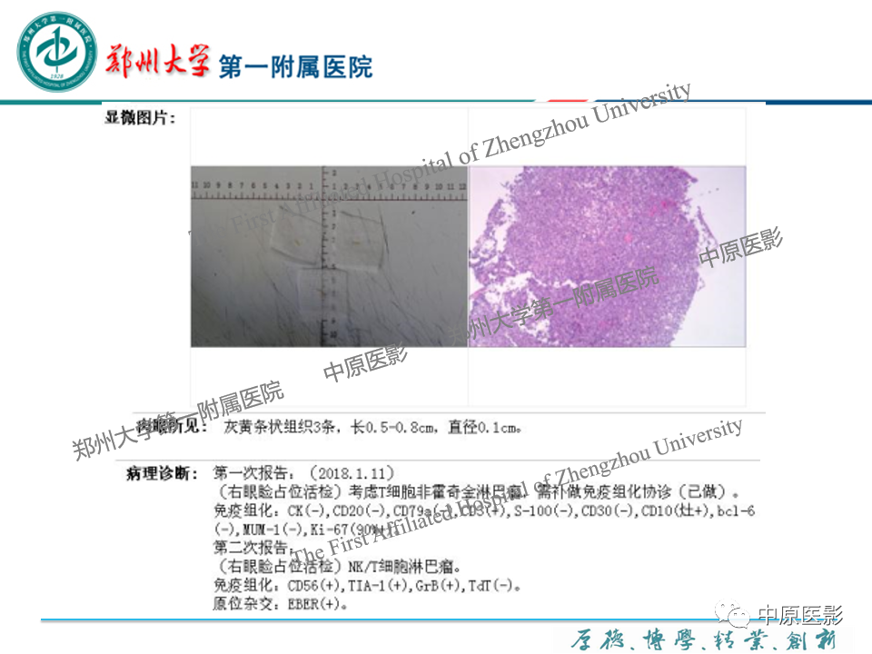 影像PPT - 【PPT】眼眶淋巴瘤的MRI诊断-18