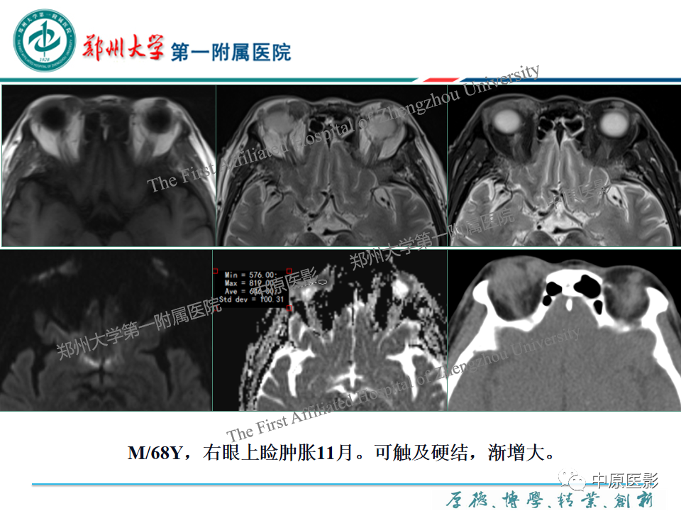 影像PPT - 【PPT】眼眶淋巴瘤的MRI诊断-25