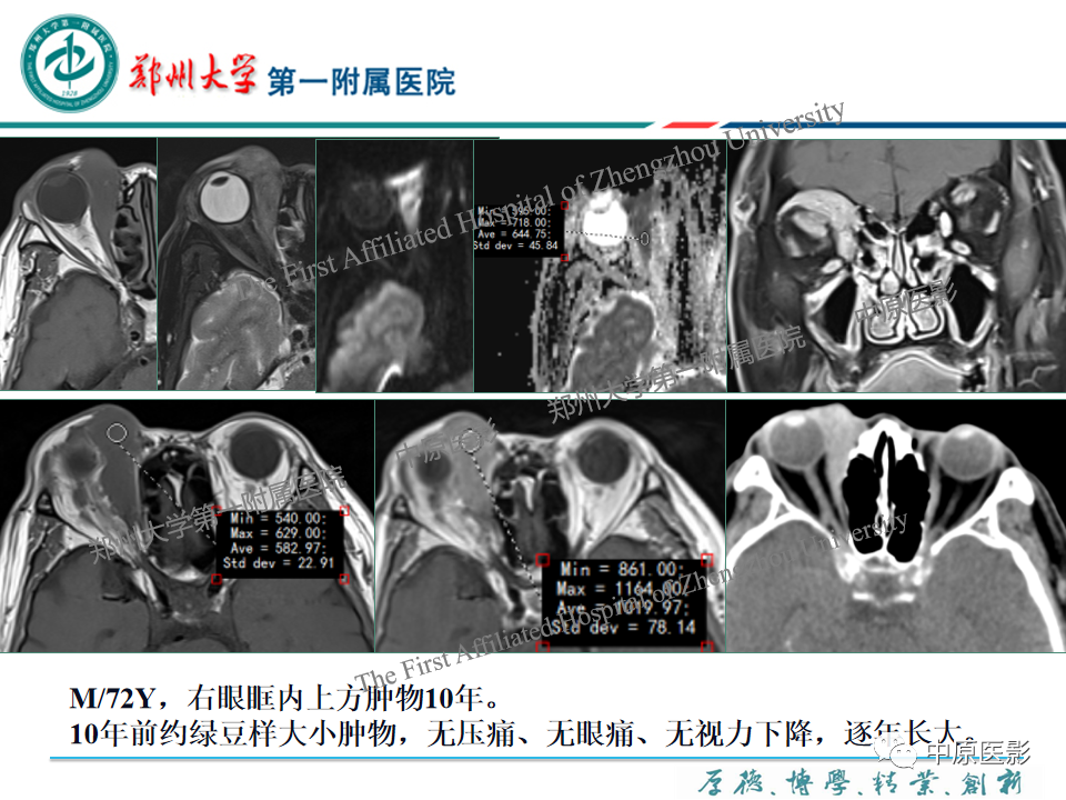 影像PPT - 【PPT】眼眶淋巴瘤的MRI诊断-22