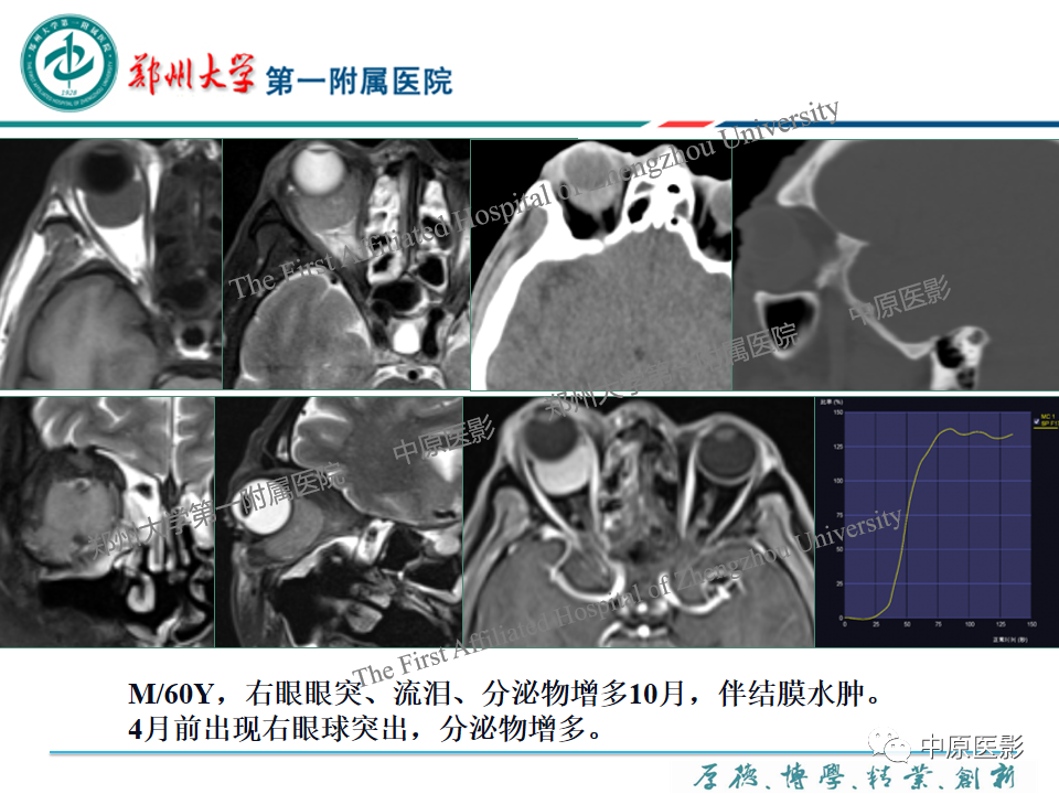 影像PPT - 【PPT】眼眶淋巴瘤的MRI诊断-28