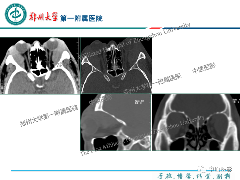 影像PPT - 【PPT】眼眶淋巴瘤的MRI诊断-51