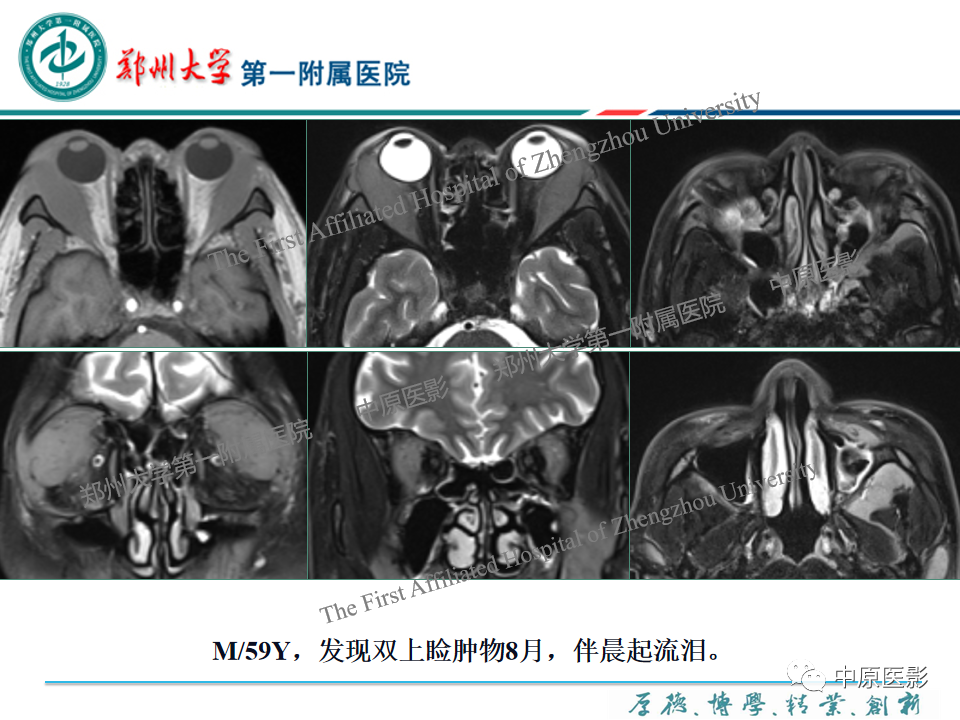 影像PPT - 【PPT】眼眶淋巴瘤的MRI诊断-50
