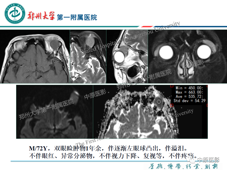 影像PPT - 【PPT】眼眶淋巴瘤的MRI诊断-47