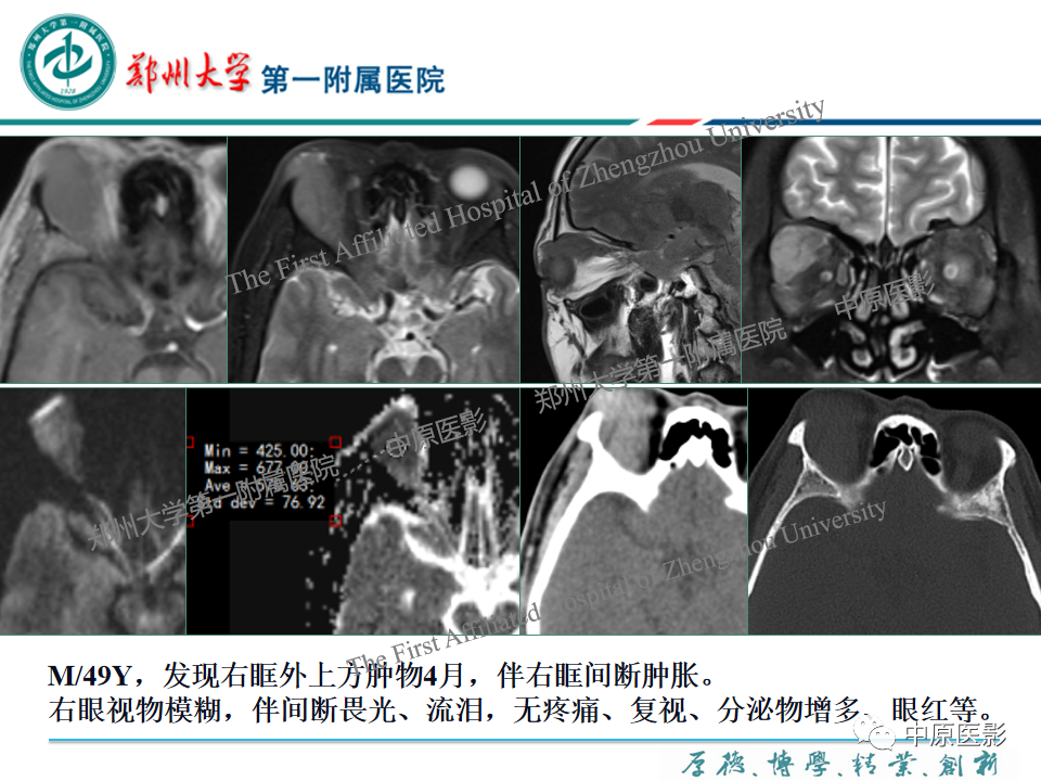 影像PPT - 【PPT】眼眶淋巴瘤的MRI诊断-44