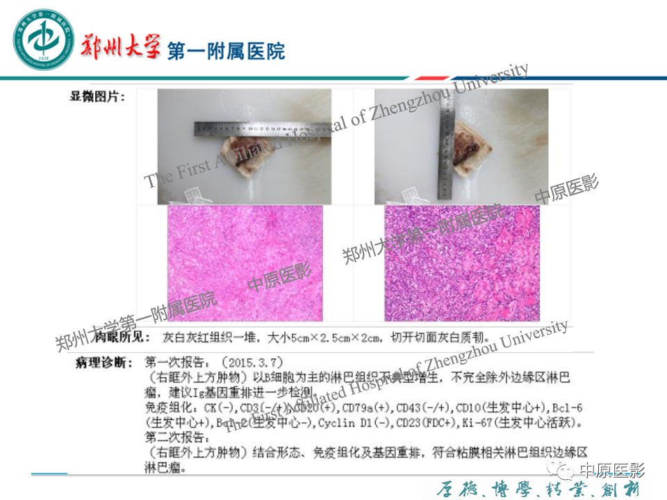 影像PPT - 【PPT】眼眶淋巴瘤的MRI诊断-46